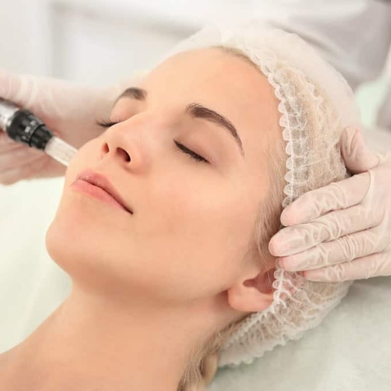 Microneedling 5 Sessions